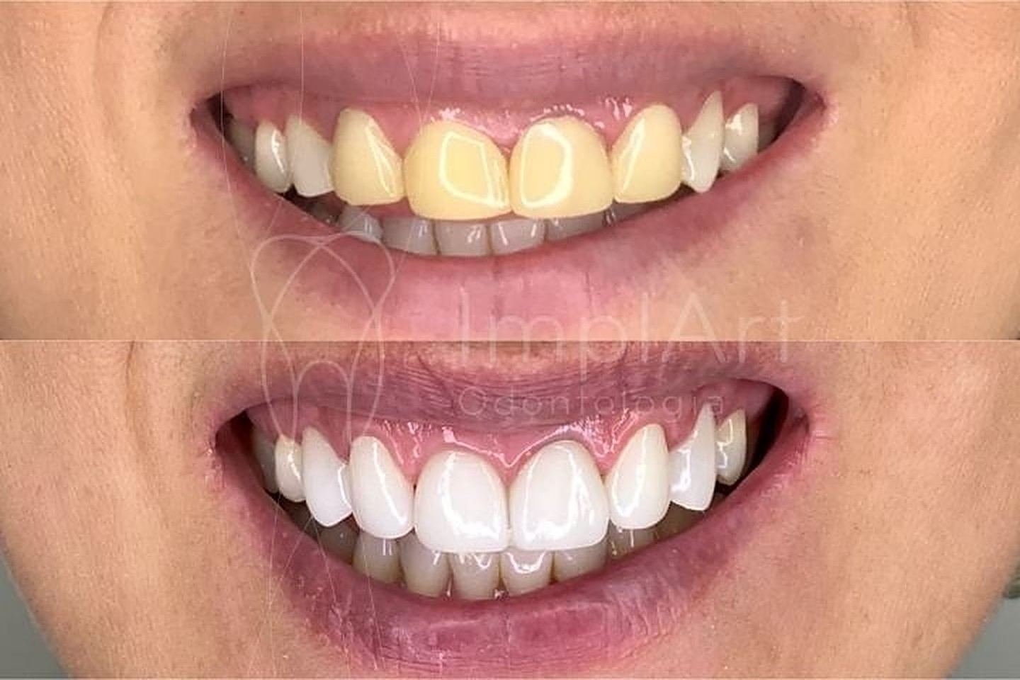 Antes e depois de lentes de contato dentais