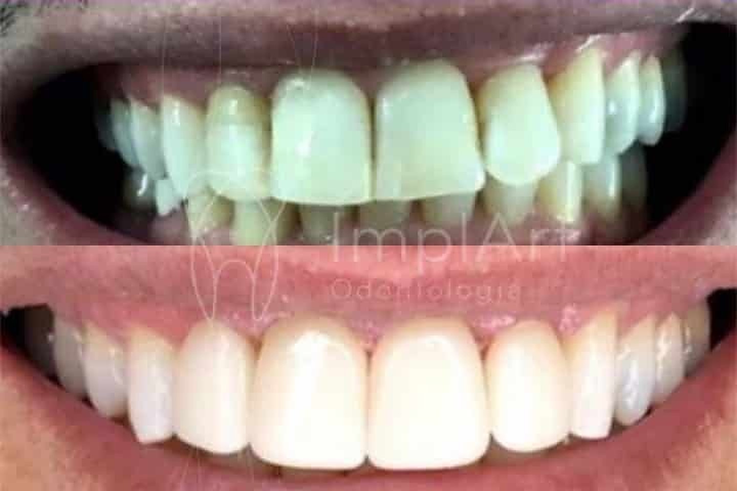 Lentes de contato dentais antes e depois