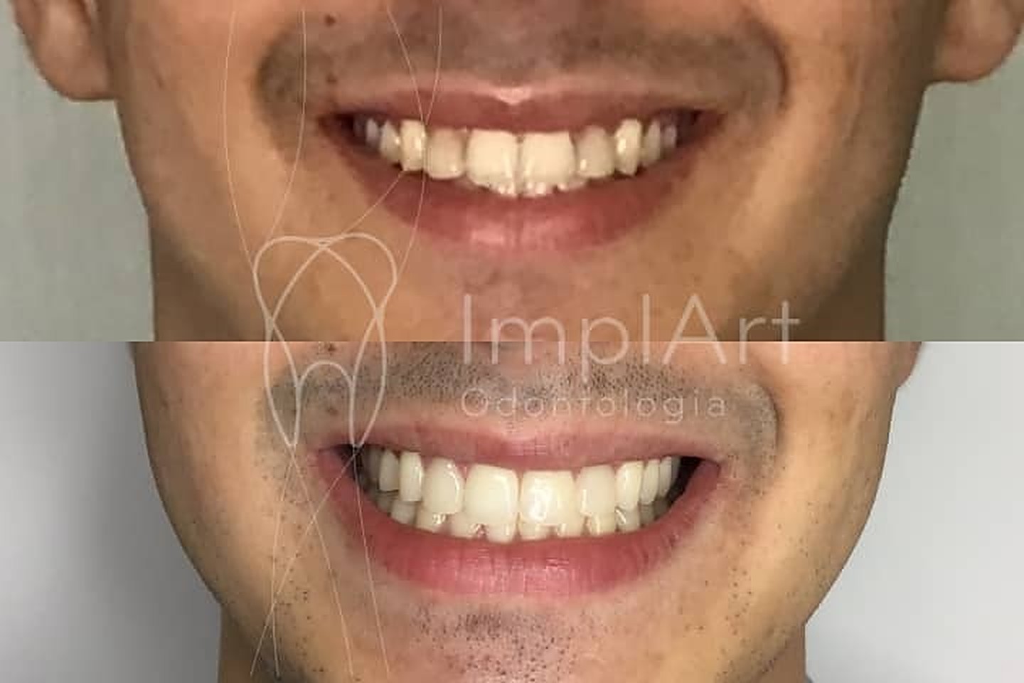 Sorriso antes e depois das lentes