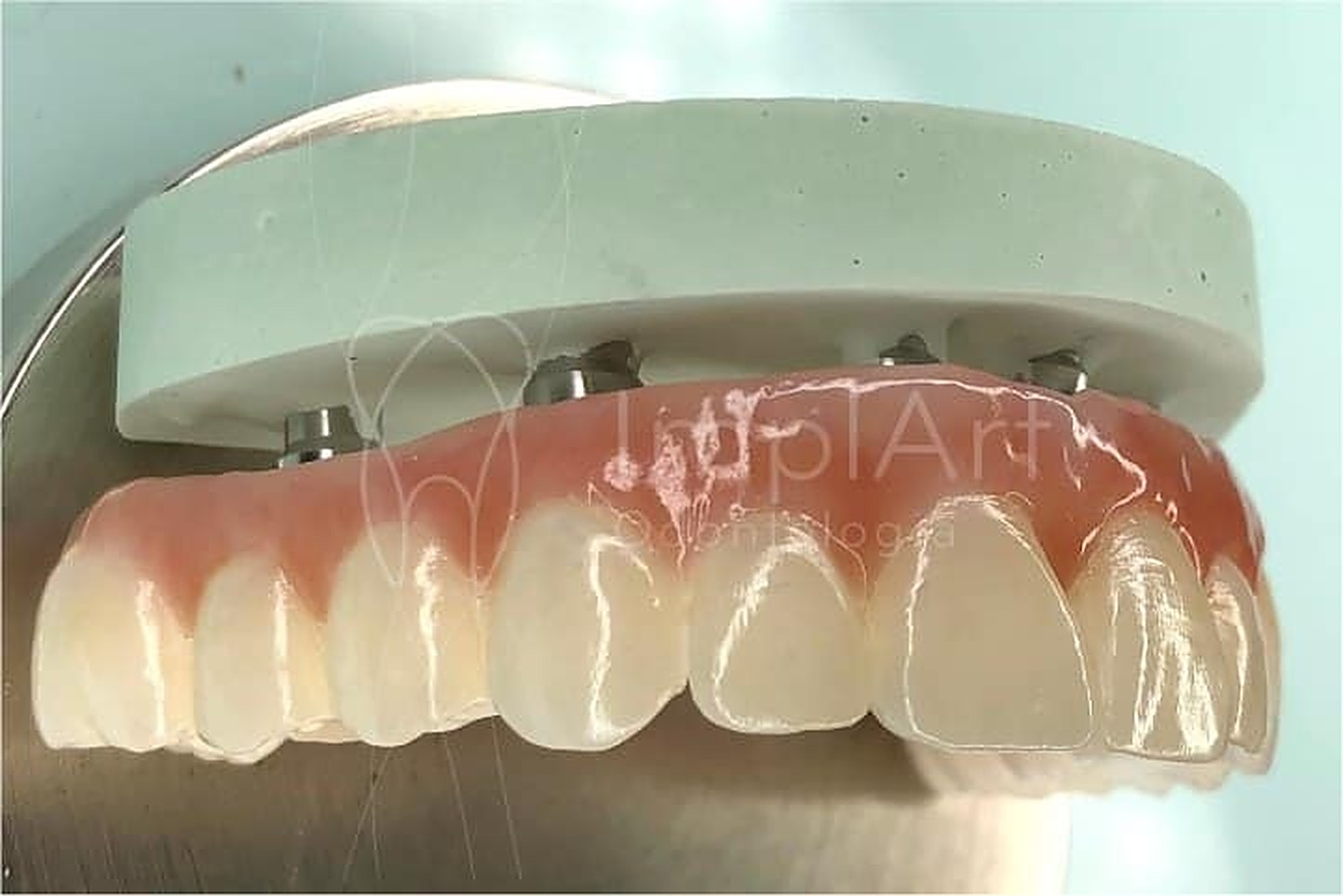 Prótese protocolo em zircônia