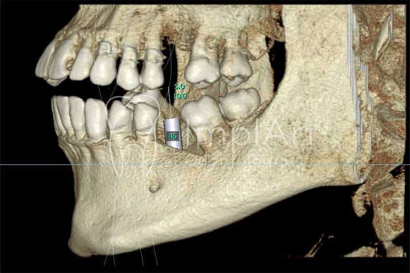 Tomografia para planejamento de implante